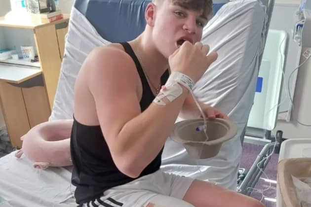 Ollie Hercombe, 16, snapped his leg spontaneously while sparring in a boxing gym and had to have his leg amputated.