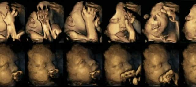 Ultrasound scans showing a sequence of movements displayed by two fetuses at 32 weeks gestation which shows fetal movements in a fetus whose mother is a smoker (top) and a fetus whose mother is a non-smoker (below).